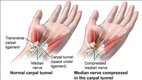 Carpal Tunnel Syndrome: Symptoms, Causes, And Treatments