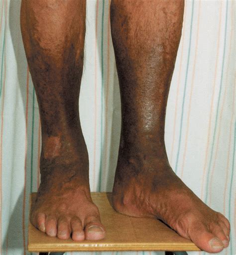 Top 94+ Images Leg Discoloration Due To Poor Circulation Pictures Updated
