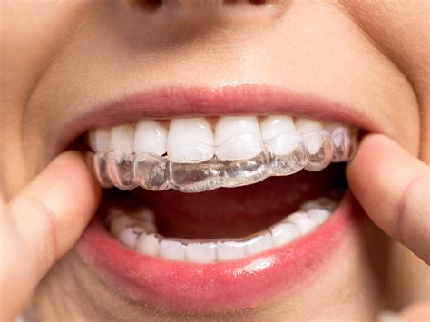 Can Invisalign fix really crooked teeth?