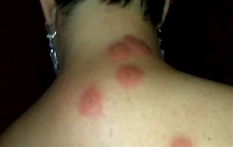 Bed Bug Bites – Pictures, Symptoms, Causes, Treatment | HubPages