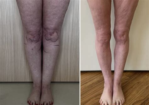 Lipedema Stage 2 Before and After - Lipedema and Me