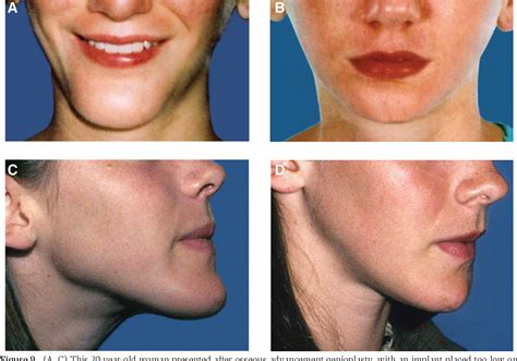 Figure 9 from Management and avoidance of complications in chin ...