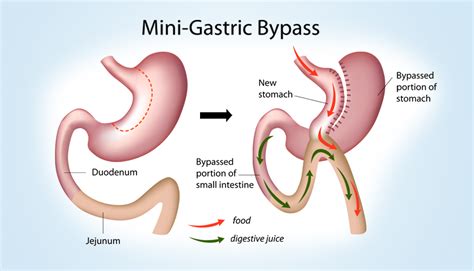 Is the Mini Bypass WLS Procedure Right For You? : ObesityHelp