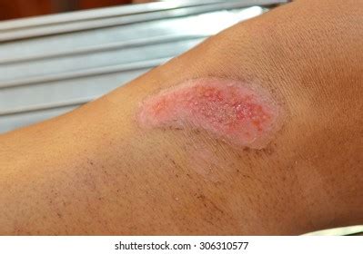 6,108 Abrasion Wound Images, Stock Photos, 3D objects, & Vectors | Shutterstock