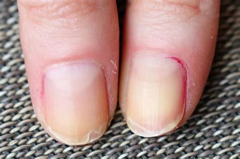 Red flag symptoms of type 2 diabetes on your nails and when to seek ...