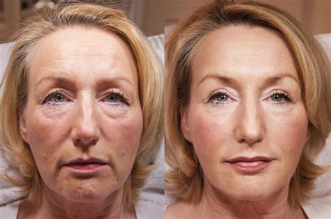 Mini facelift vs full facelift what you need to know – Artofit