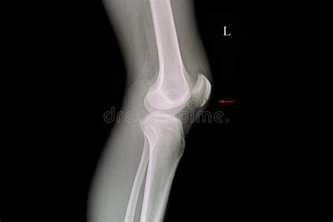 X Ray Film of a Patient with Fractured Patella Stock Photo - Image of ...