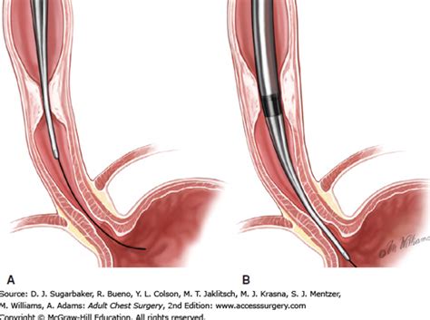 Expert Esophageal Surgery