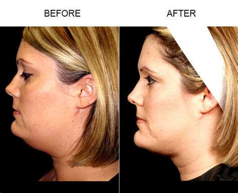 Facial Liposuction Orlando, Neck Liposuction Florida, Chin Liposuction ...