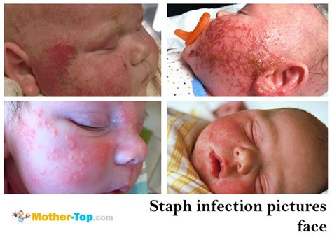 Staph infection and MRSA symptoms in newborns | mother-top.com