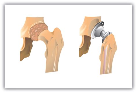 Types of Hip Joint Replacement | Faculty of Medicine