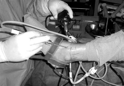 Ankle arthroscopic procedure in the operating room. | Download Scientific Diagram