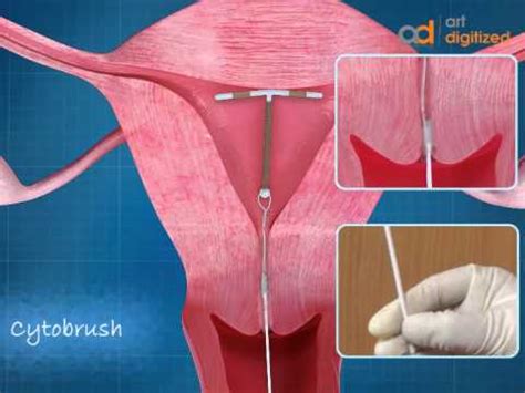 Iud In Uterus Diagram