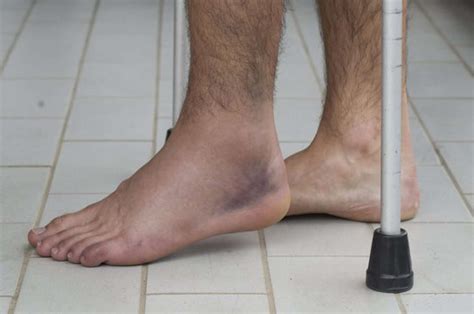 Swollen Ankle After Knee Replacement: 8 Best Treatments