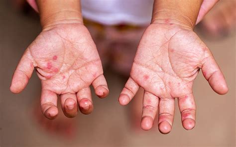 Hand Foot Mouth Disease (HFMD): How to Prevent and Treat - HealthXchange.sg