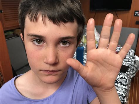 The Boat Doctor is IN: Update on Aden's Hand — Harris Crew