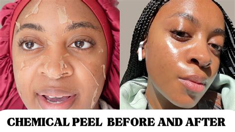 Before and After Chemical Peel Black Skin: See the WOW Results!