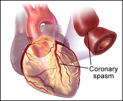 Coronary Artery Spasm Adalah - Best Design Idea