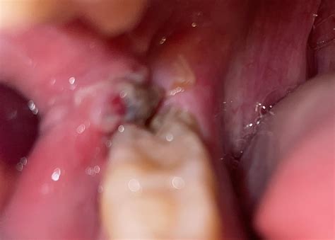 Wisdom Tooth Complication? : r/wisdomteeth