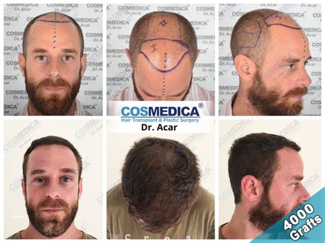 39+ artas hair transplant before and after - DillonHamaad