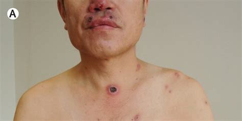 GRAPHIC IMAGES: Malignant Syphilis Photos Powerfully Demonstrate The Impact It Has On The Body ...