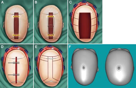 A review of the management of single-suture craniosynostosis, past ...