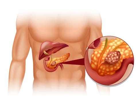 Pancreas imágenes de stock de arte vectorial | Depositphotos