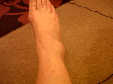 Broken Ankle - Symptoms, Recovery time, Pictures, Surgery, Treatment - (2018 - Updated)