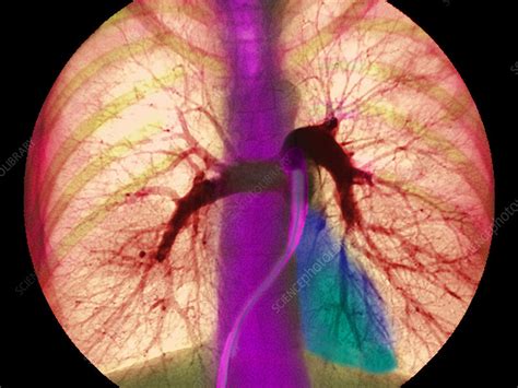 Coloured angiogram showing the pulmonary arteries - Stock Image - P206/0146 - Science Photo Library