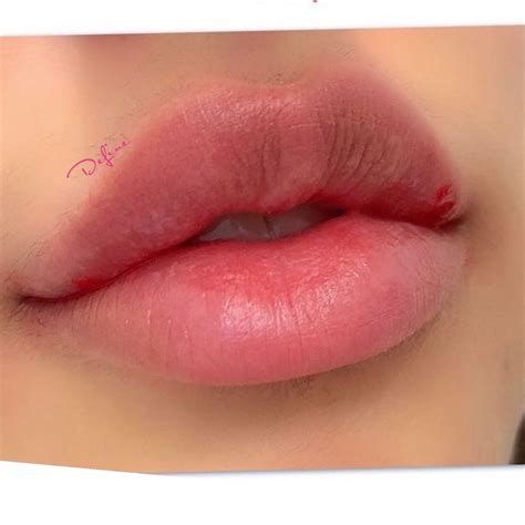 The perfect bow shaped lip 🎀 in 2021 | Dermal fillers lips, Lip fillers, Lip augmentation