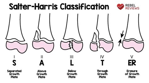 Salter-Harris Fracture Classification - REBEL EM - Emergency Medicine Blog