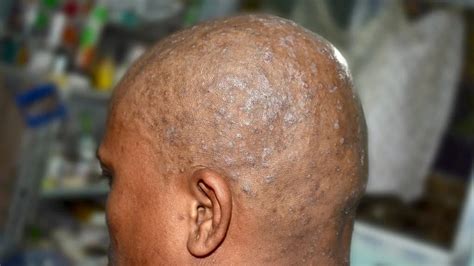 Pictures of sores and scabs on scalp: Causes and more