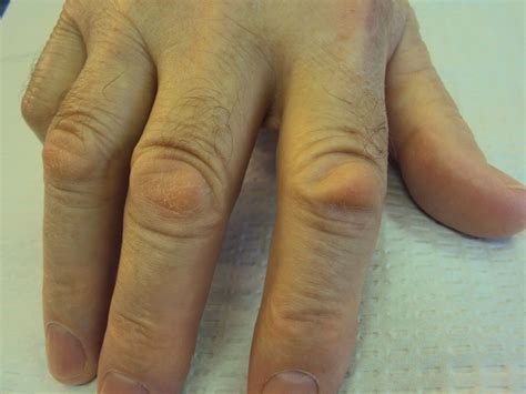 Dupuytren's: Knuckle Pads: Dorsal Dupuytren Nodules