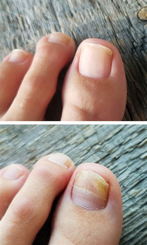 Treat Fungal Nails | Laser Therapy | Nassau County