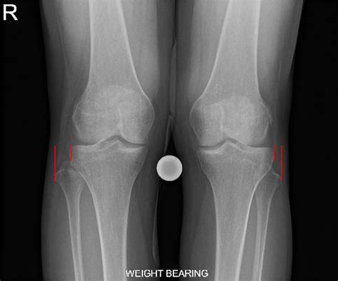 Proximal Tibiofibular Joint Instability | Radsource