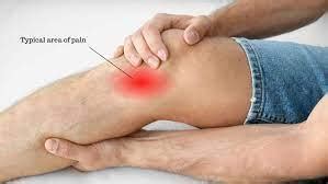 Pes Anserine Knee Tendon Bursitis Physiotherapy | Simply Align Rehab