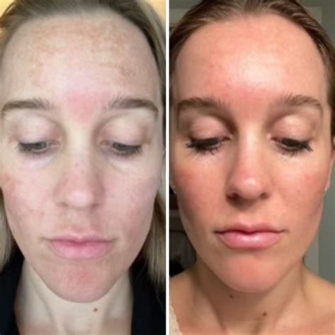 Moxi Melasma Laser Facial | Columbus | Boss Gal Beauty Bar