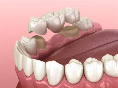 Pontic Tooth: A Dental Solution for Missing Teeth - Universal Society ...