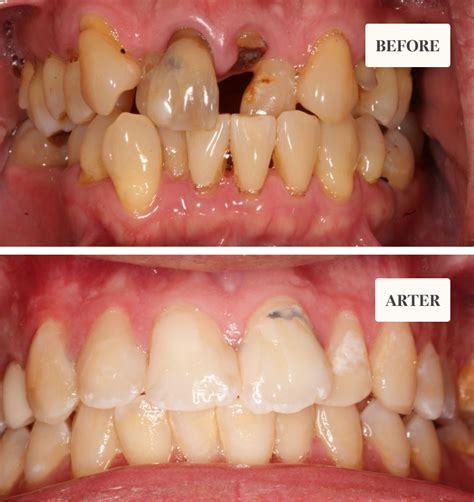 Before And After - Southshore Dental