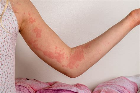 What Causes Hives (Urticaria)?