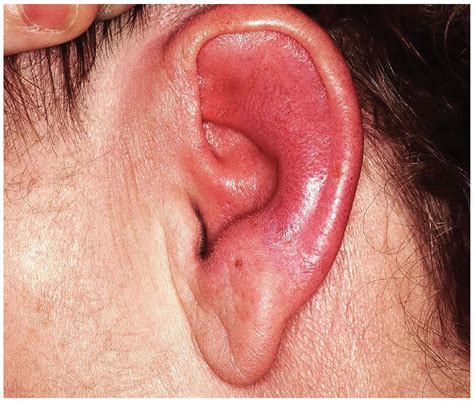 Seeing Redness and Ear-itation | Clinician Reviews