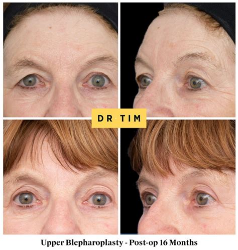 Eyelid Lift Surgery Sydney | Blepharoplasty Surgery | Dr Tim