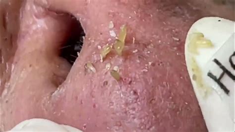 Nose Blackheads Removal with Hari's Beauty - 2022 - YouTube