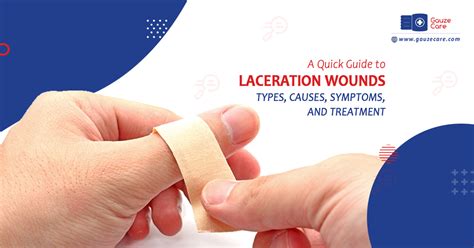 Quick Guide To Laceration Wounds: Causes, Types & Treatment