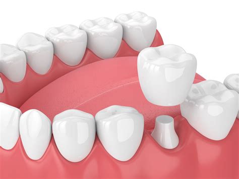 Top 6 Types of Dental Crown Material