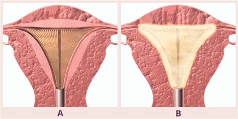 Endometrial Ablation - Center for Advanced Gyn & Urogynecology