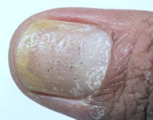Psoriasis Under The Toenails: [Nail Pits, Causes & Best Treatment]