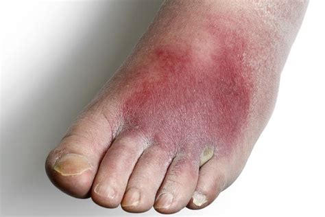 Cellulitis From Bug Bite On Foot Cheap Sale | emergencydentistry.com