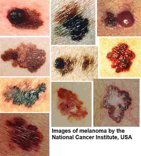 Healthy Horizons! : Warning Signs of Melanoma, The Most Deadly Form Of ...