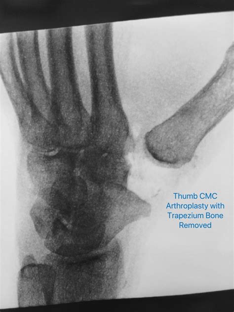 Thumb Arthritis Treatment in Raleigh by Dr. Erickson